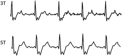 Bi-ventricular assessment with cardiovascular magnetic resonance at 5 Tesla: A pilot study